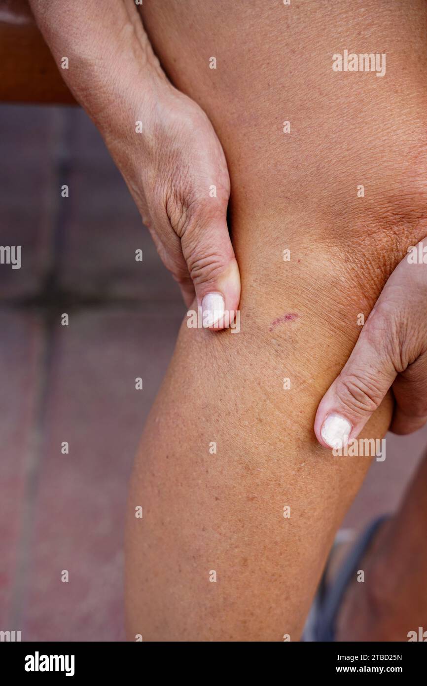 closeup of a scratch on the skin near the knee. Pain in the leg Stock ...