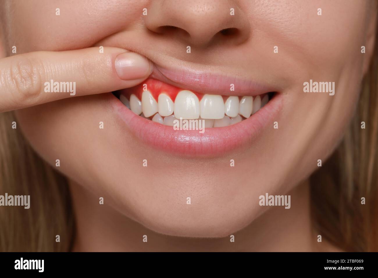 Woman showing inflamed gum, closeup. Oral cavity health Stock Photo