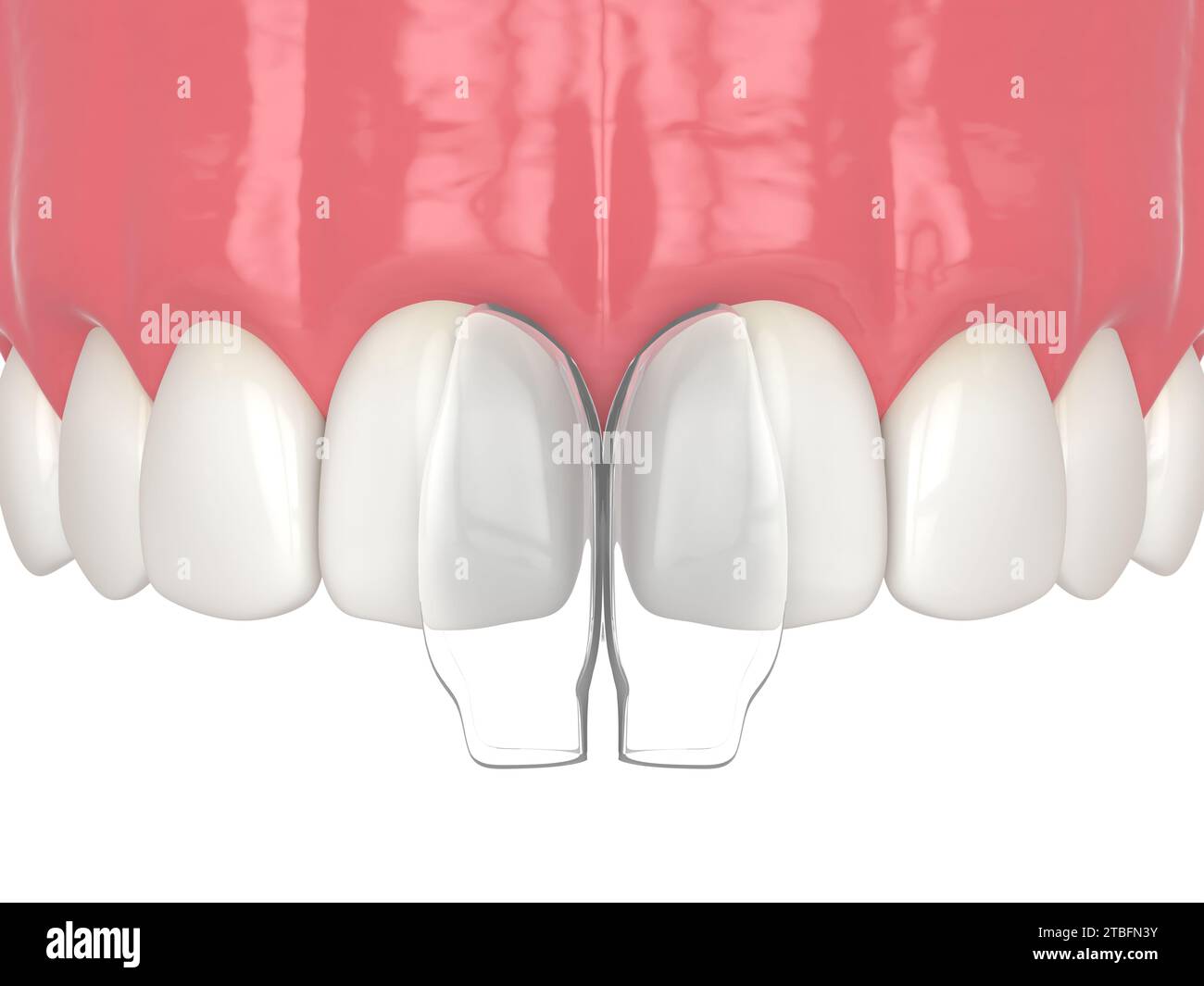 3d render of diastema closure using bonding procedure. Part 4