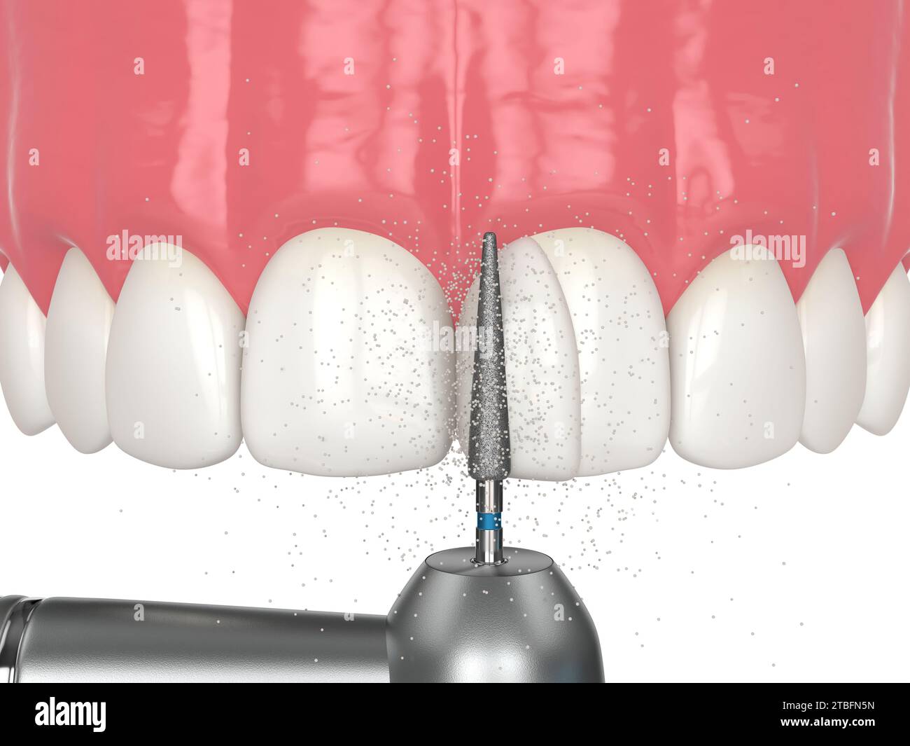 3d render of diastema closure using bonding procedure. Part 7. Using a