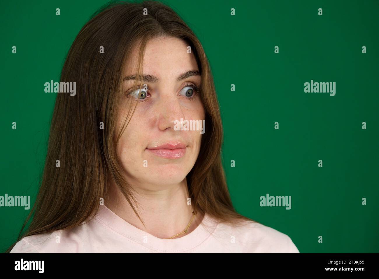 Macro Closeup Of Young Woman Face With Grave's Disease Hyperthyroidism 