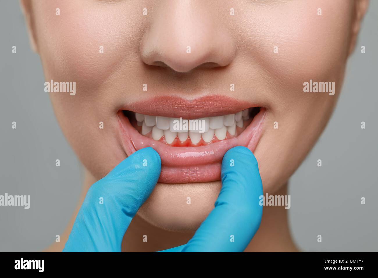 Doctor examining woman's inflamed gum on grey background, closeup Stock Photo