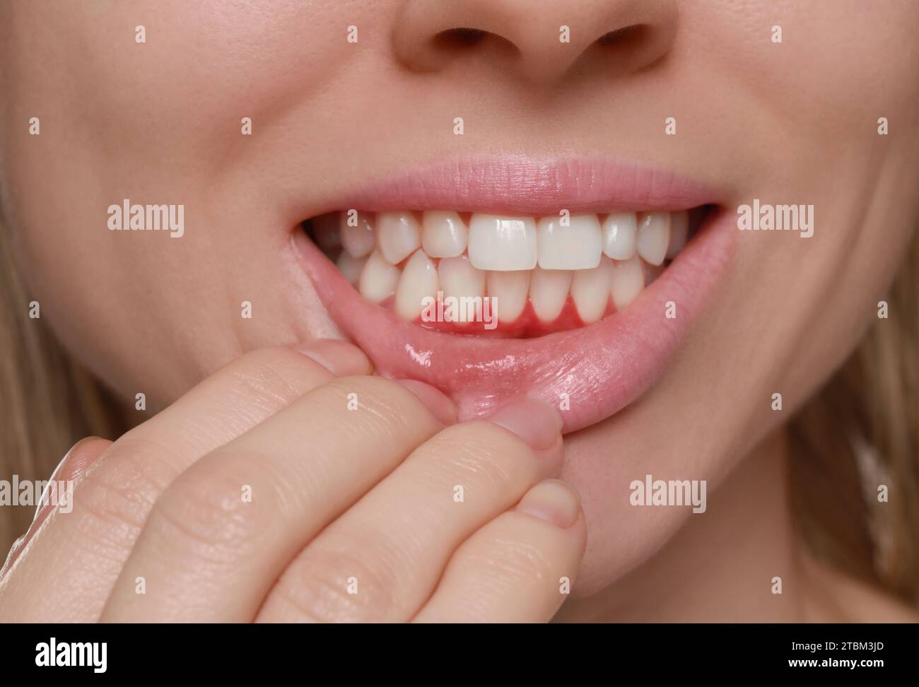 Woman showing inflamed gum, closeup. Oral cavity health Stock Photo