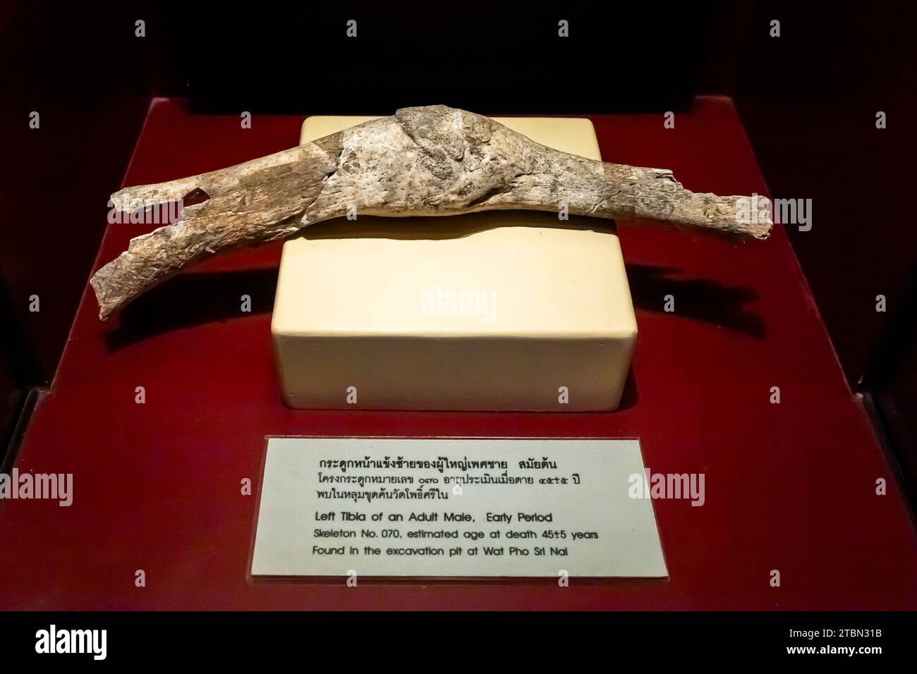 Ban Chiang national museum, left tibia of adult male, Healing traces, Ban Chiang, Udon Thani, Thailand, Southeast Asia, Asia Stock Photo