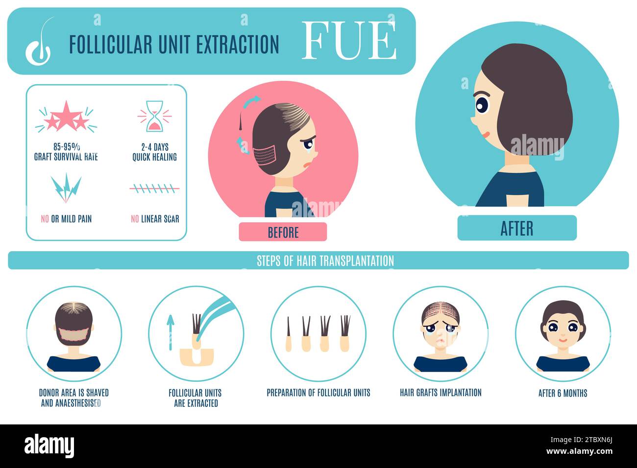 FUE hair transplantation, conceptual illustration Stock Photo