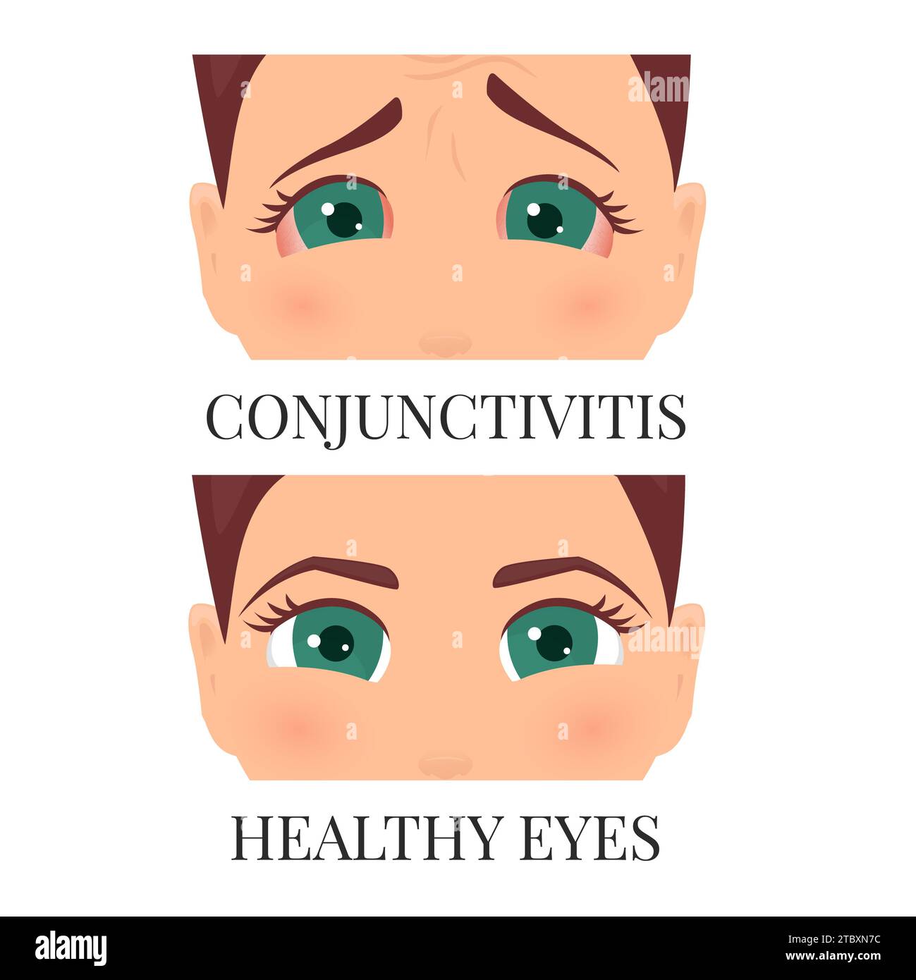 Conjunctivitis, conceptual illustration Stock Photo