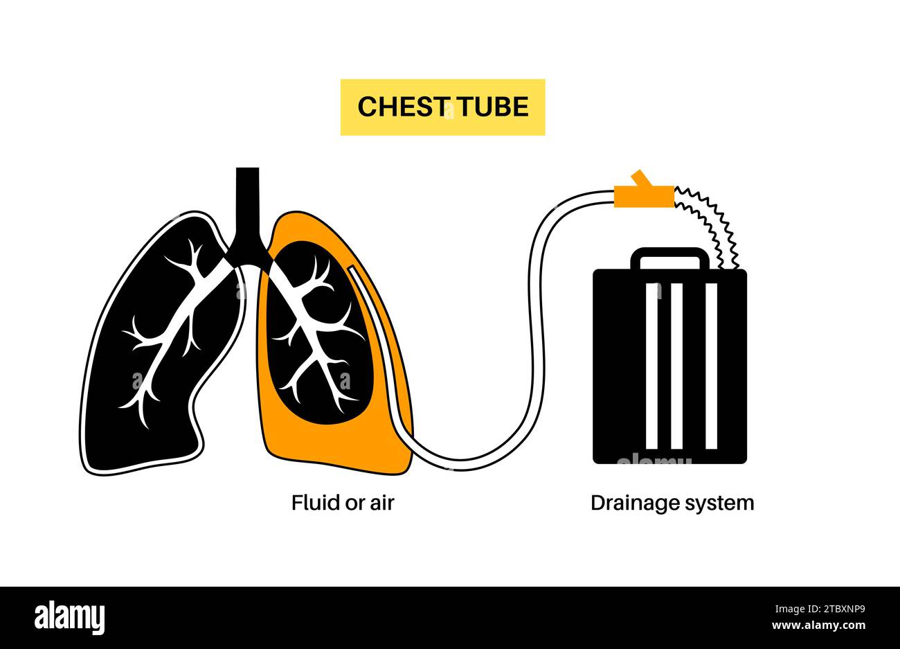 Chest tube catheter, illustration Stock Photo Alamy