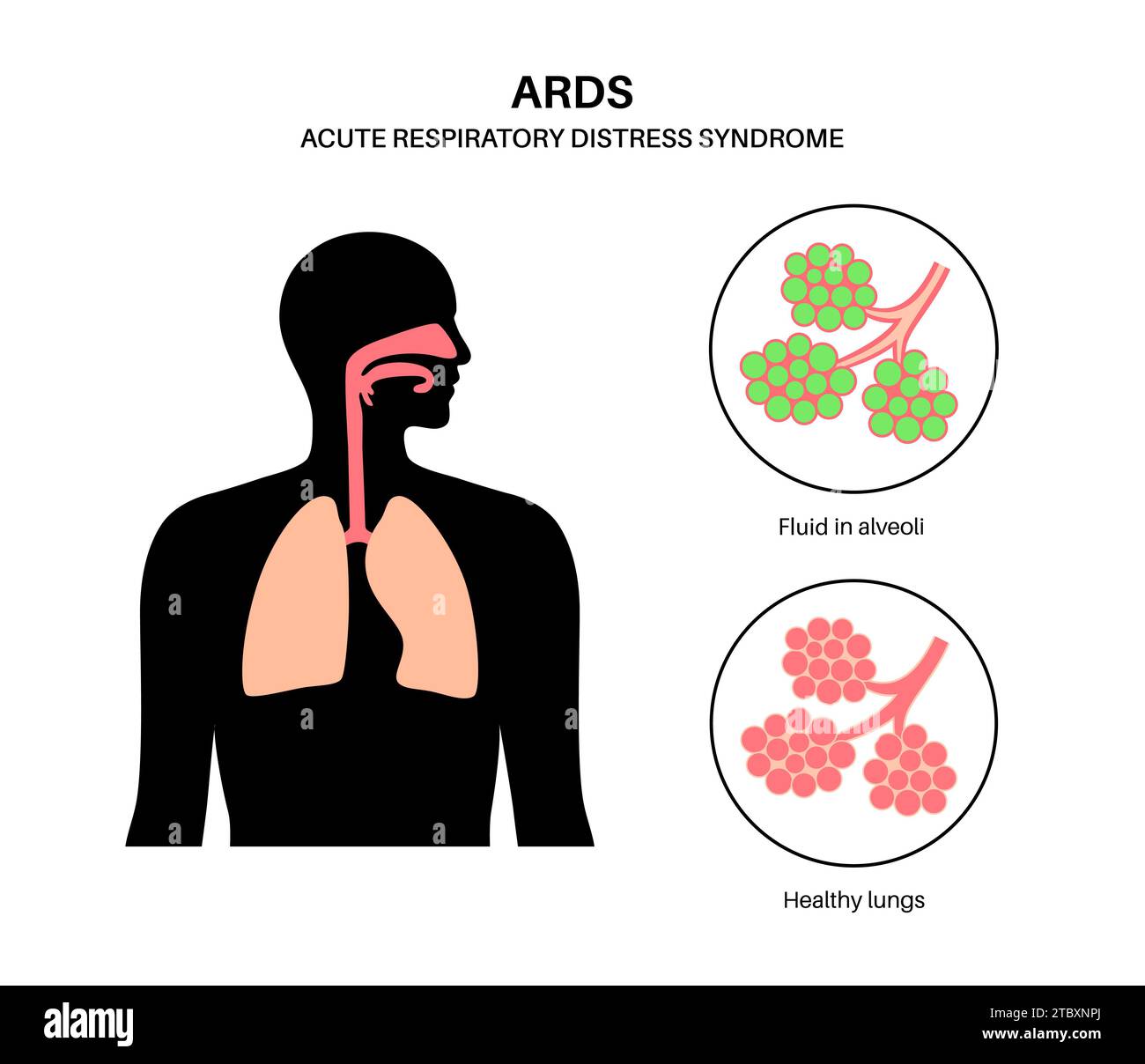 Respiratory distress Cut Out Stock Images & Pictures Alamy