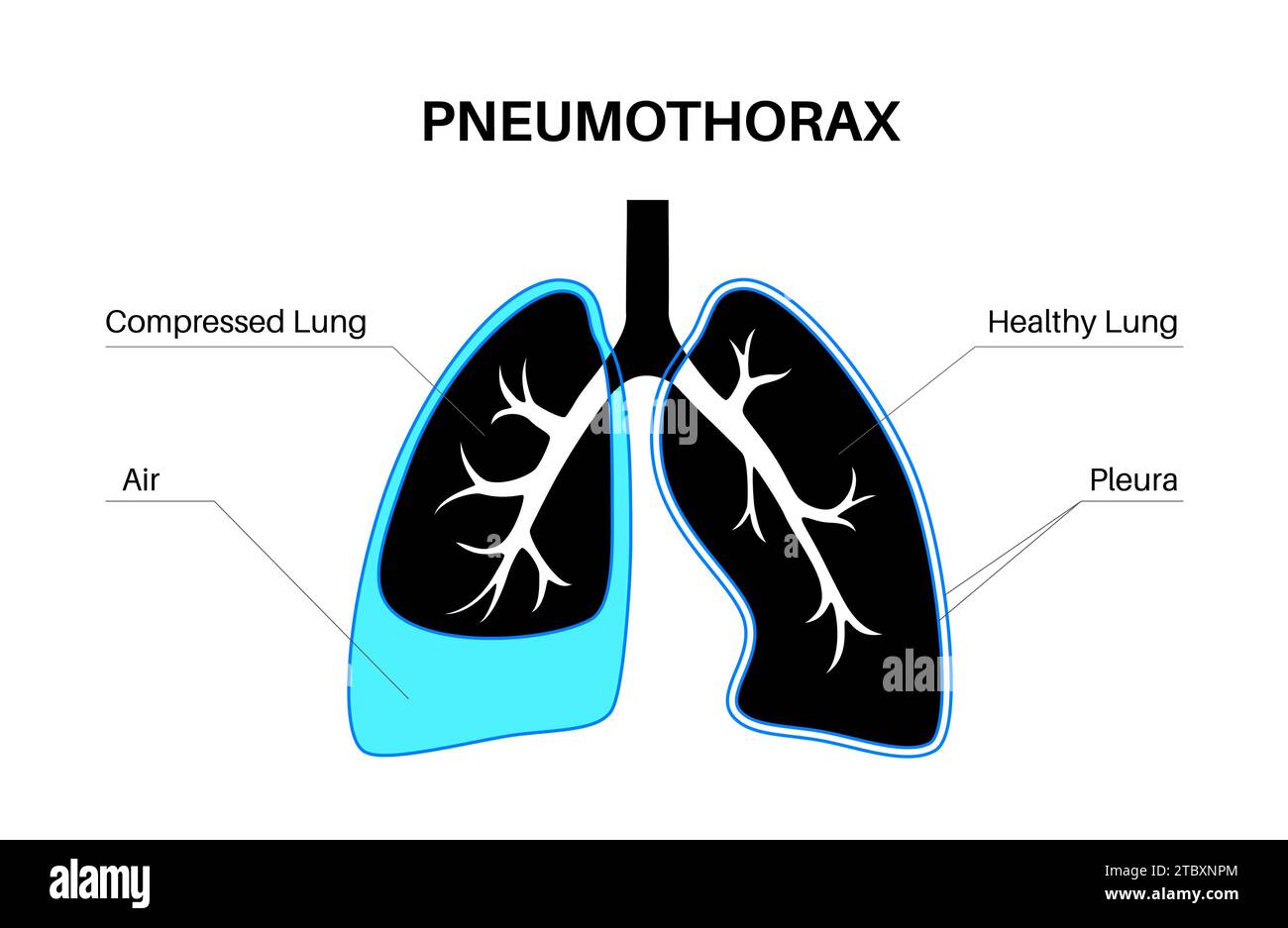 Pneumothorax collapsed lung hires stock photography and images Alamy