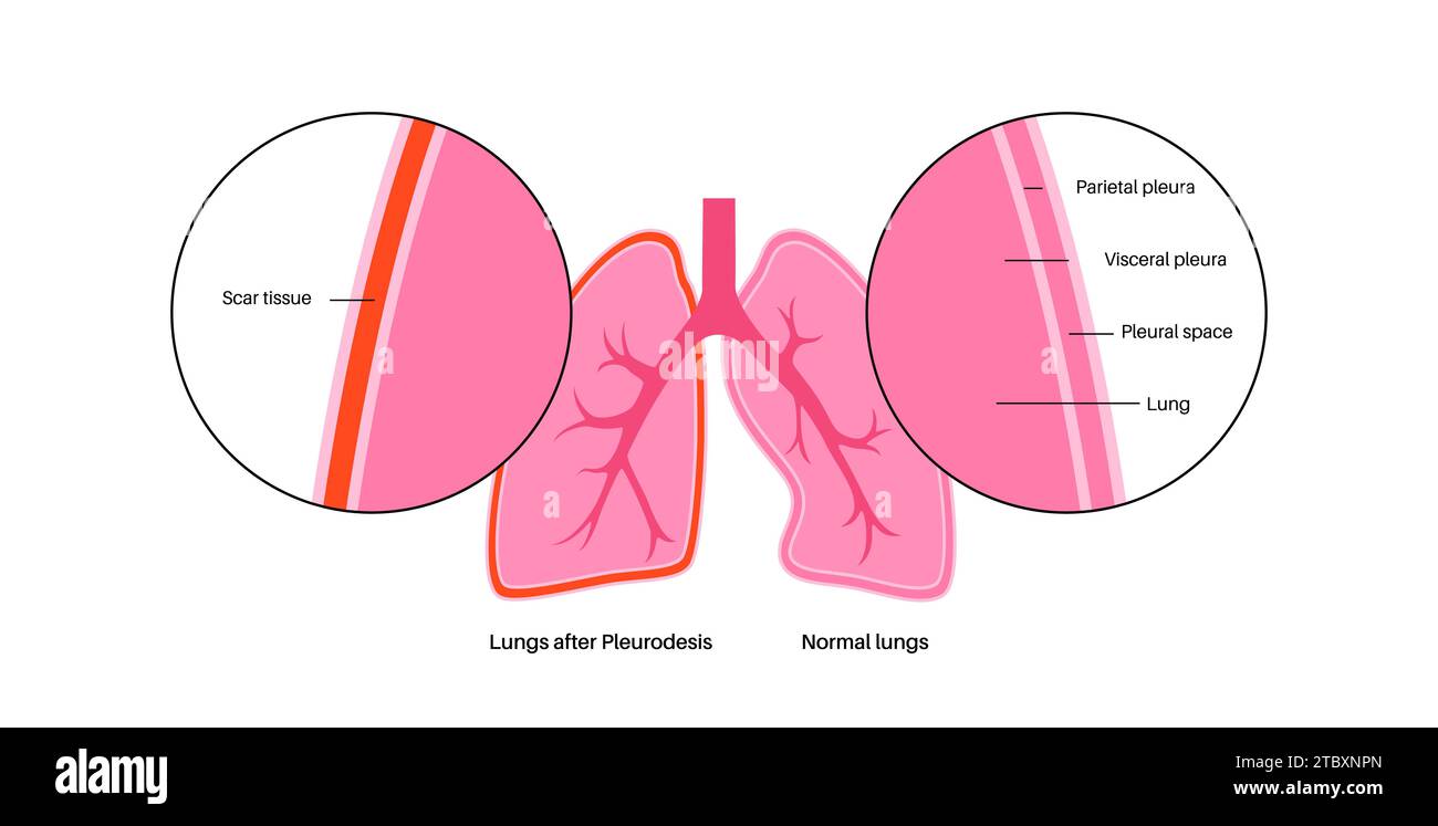 Pleurodesis medical procedure, illustration Stock Photo