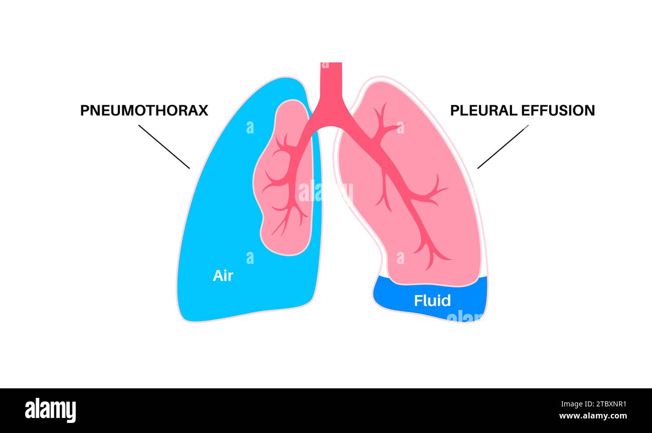 Pleural effusion and pneumothorax, illustration Stock Photo Alamy