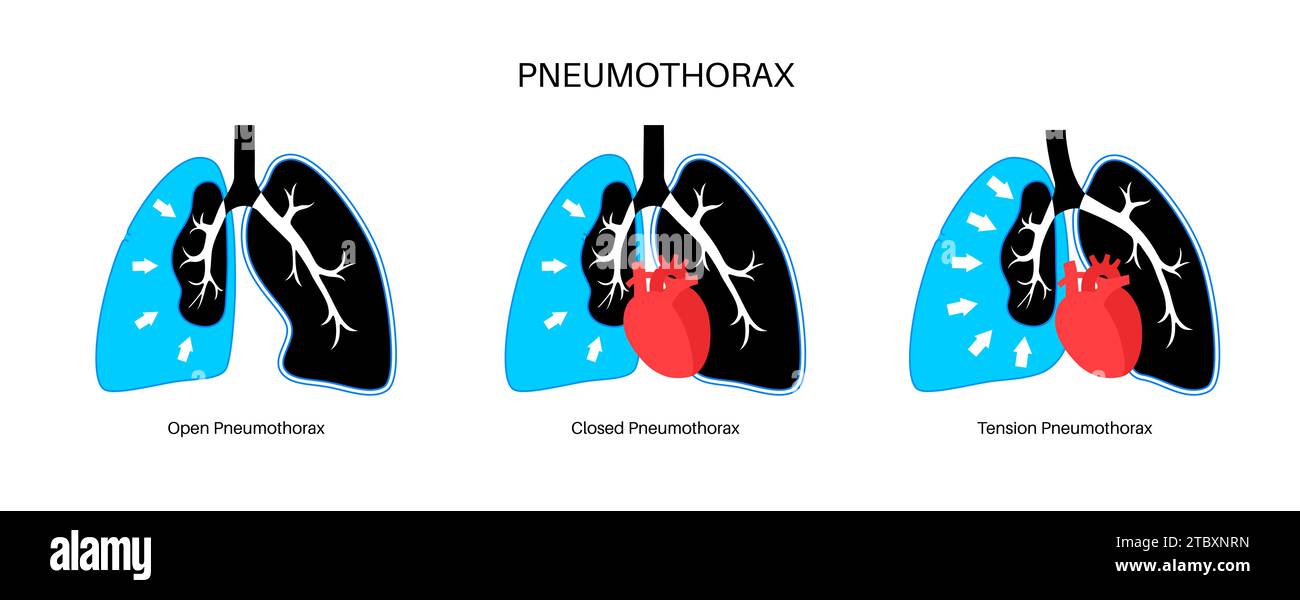 Pneumothorax collapsed lung hires stock photography and images Alamy