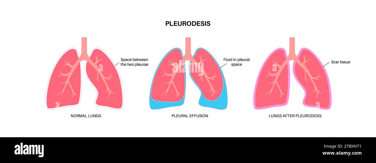 Pleurodesis medical procedure, illustration Stock Photo