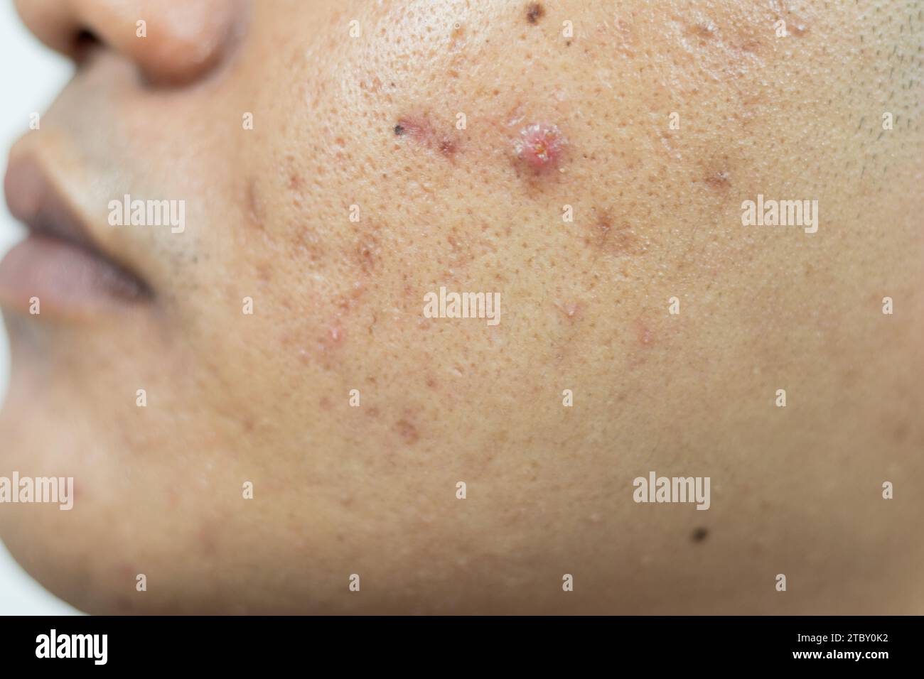 skin problems. problem of inflamed acne on the face. Inflamed acne consists of swelling, redness, and pores that are severely clogged with bacteria, o Stock Photo