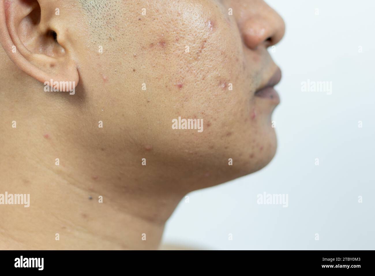 skin problems. problem of inflamed acne on the face. Inflamed acne consists of swelling, redness, and pores that are severely clogged with bacteria, o Stock Photo