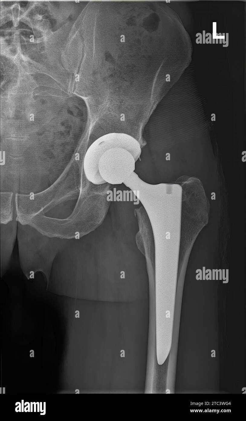 Xray photo of left hip prosthesis of man. Total hip replacement. 6