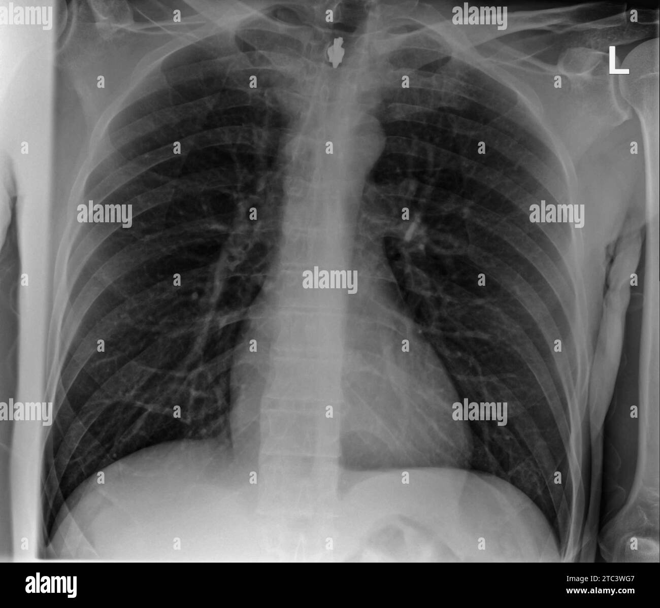 Chest xray photo of man, with lungs, thoracic spine and thoracic cage