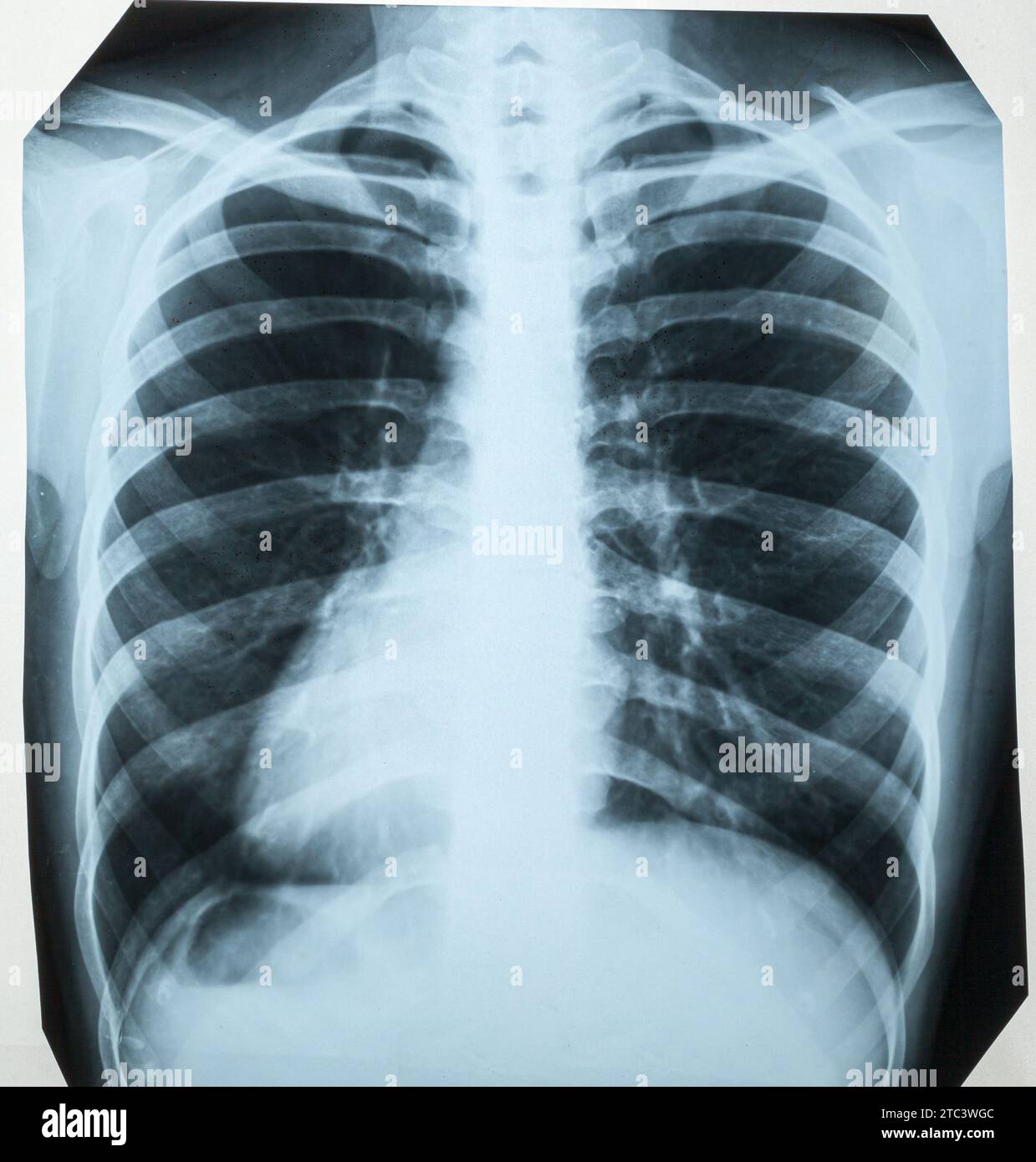 Chest xray photo of woman, with lungs, thoracic spine and thoracic