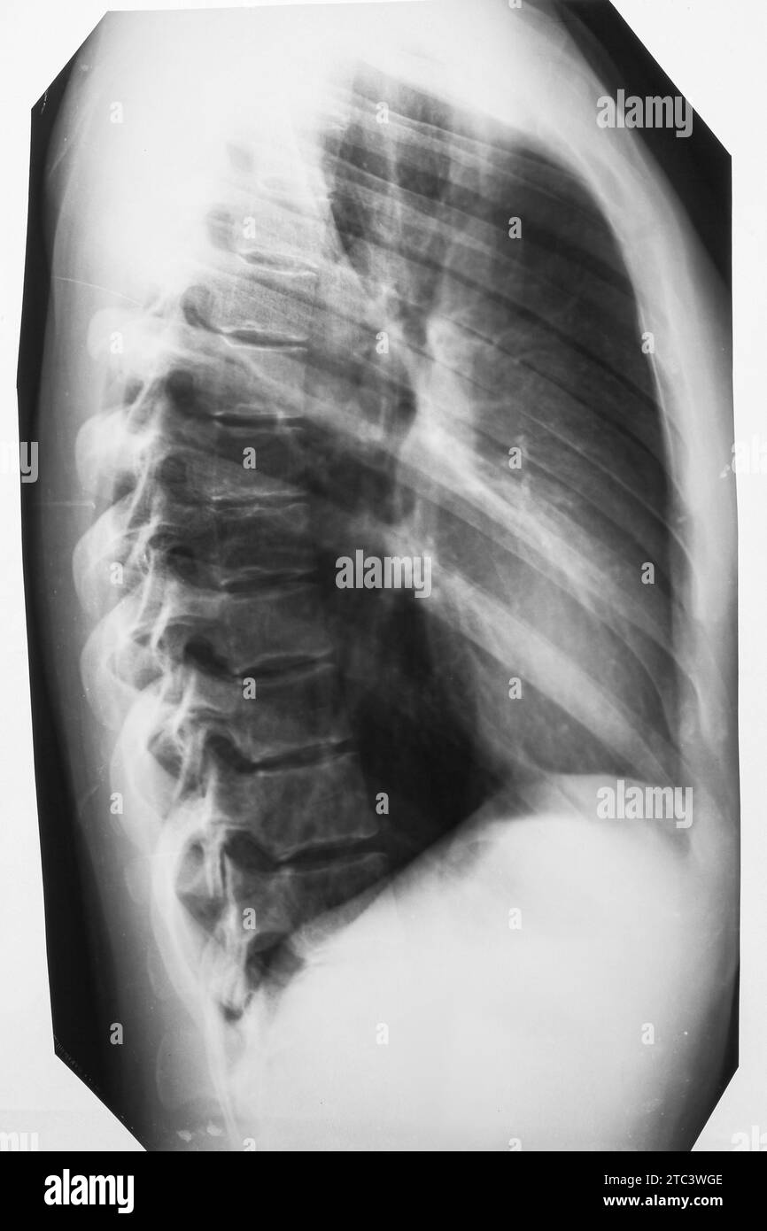 Chest xray photo of woman, with lungs, thoracic spine and thoracic