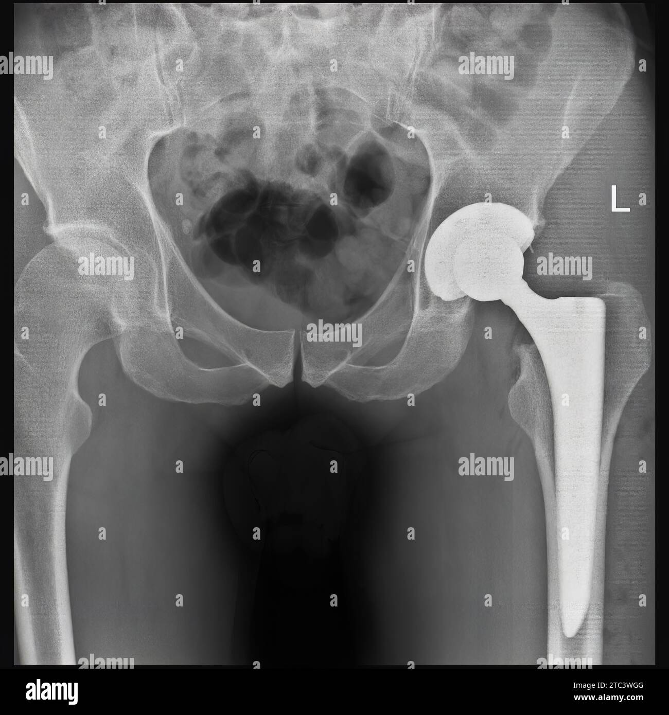 Left femoral neck fracture. Xray photo of man. Roentgenogram. Next day