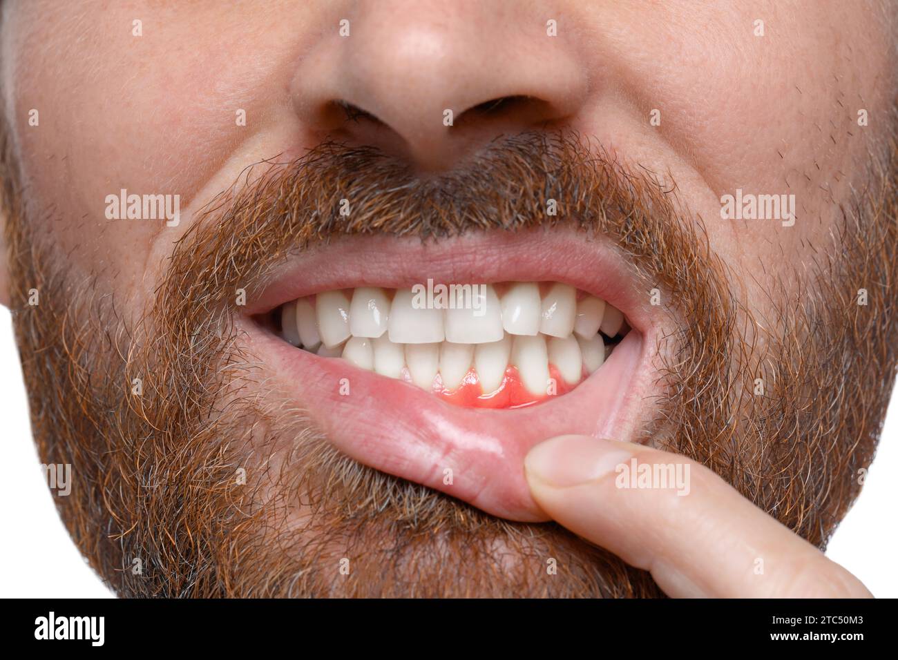 Man showing inflamed gum, closeup. Oral cavity health Stock Photo