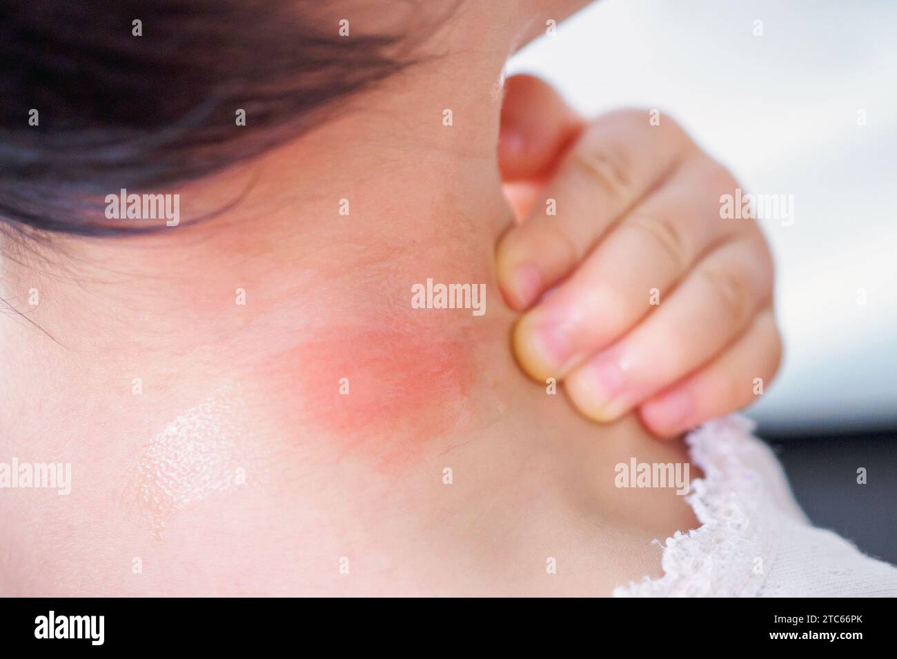 baby skin rash and allergy with red spot cause by mosquito bite at neck Stock Photo