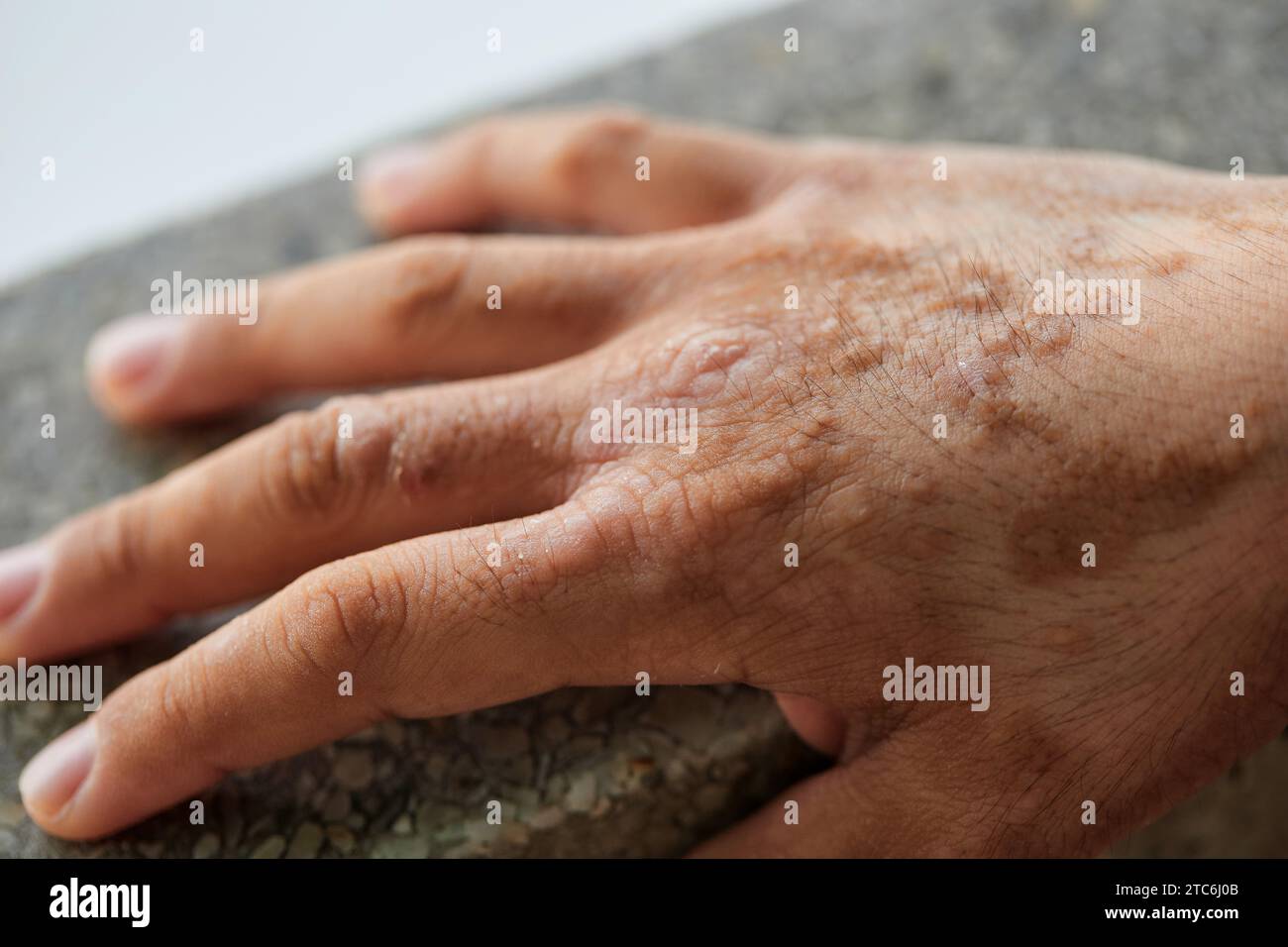 Close-up of Chronic skin diseases dermatitis Stock Photo