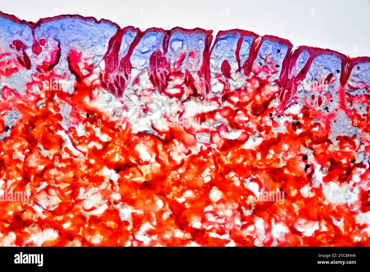 Human skin with scabies, produced by a mite (Sarcoptes scabiei hominis). Light microscope X50 at 10 cm wide. Stock Photo
