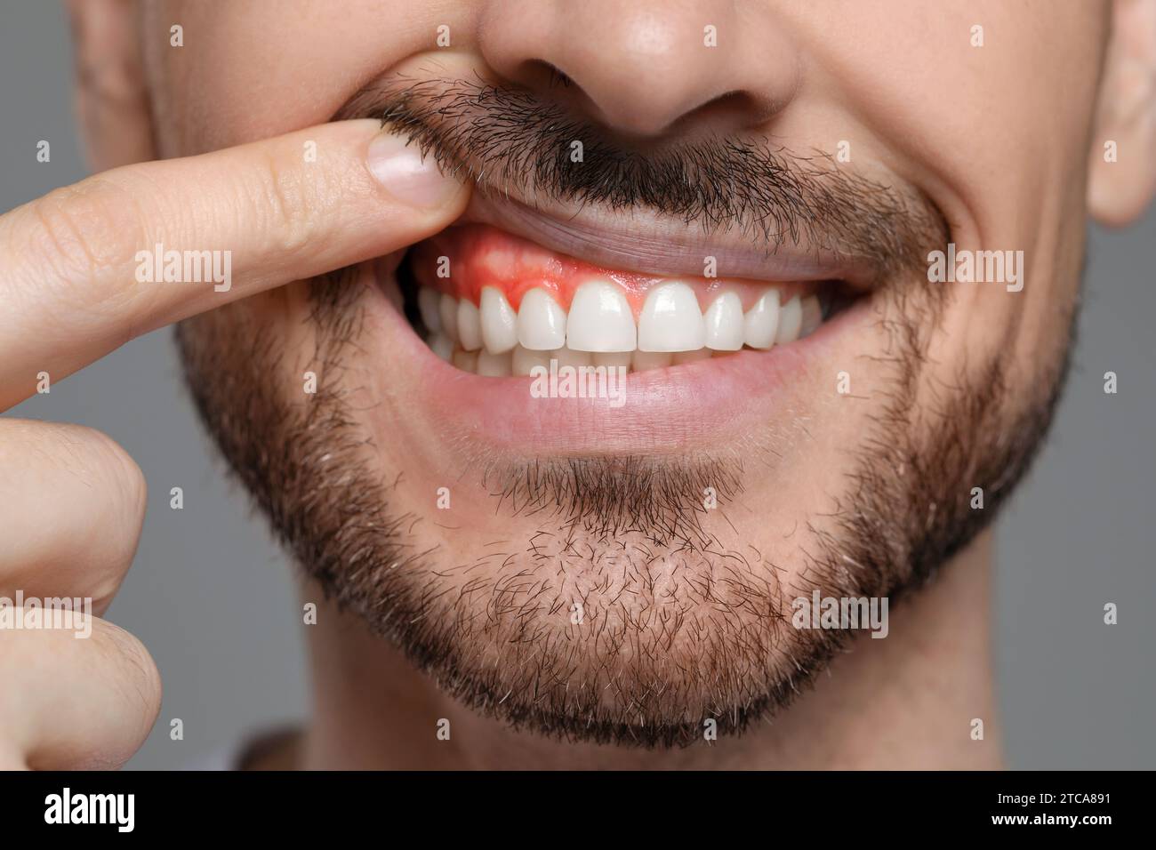 Man showing inflamed gum on grey background, closeup Stock Photo