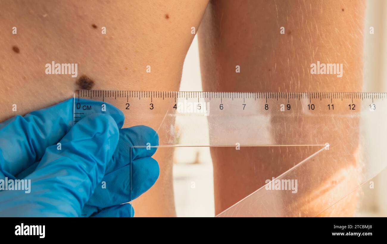 Skin test ruler hi-res stock photography and images - Alamy