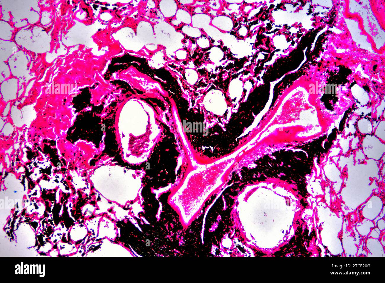 Human smoker lung with anthracosis. Optical microscope X40 Stock Photo Alamy