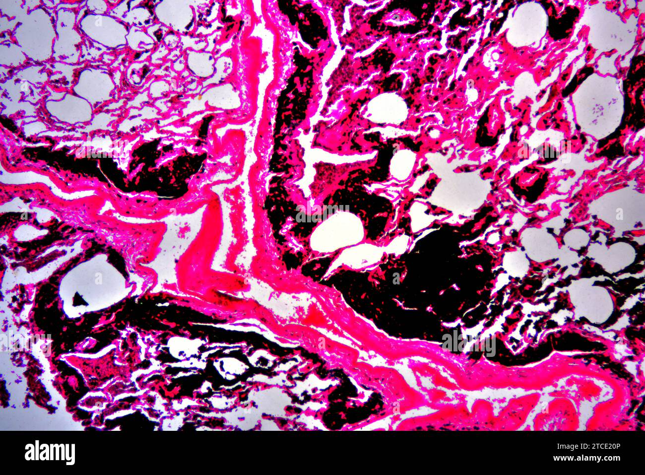 Human smoker lung with anthracosis. Optical microscope X40 Stock Photo Alamy