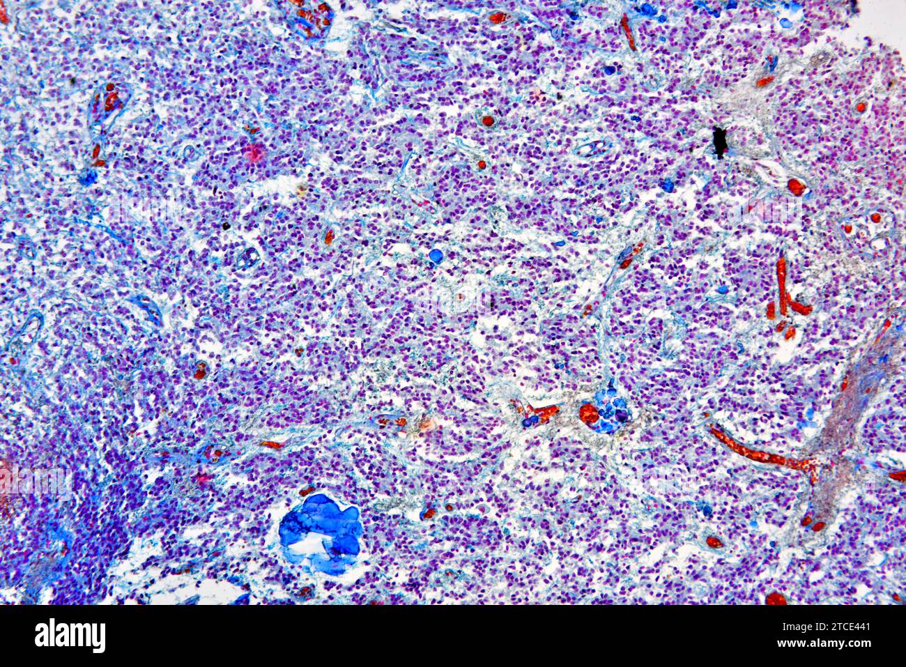 Normal pineal gland producing melatonin and serotonin. Optical microscope X100. Stock Photo