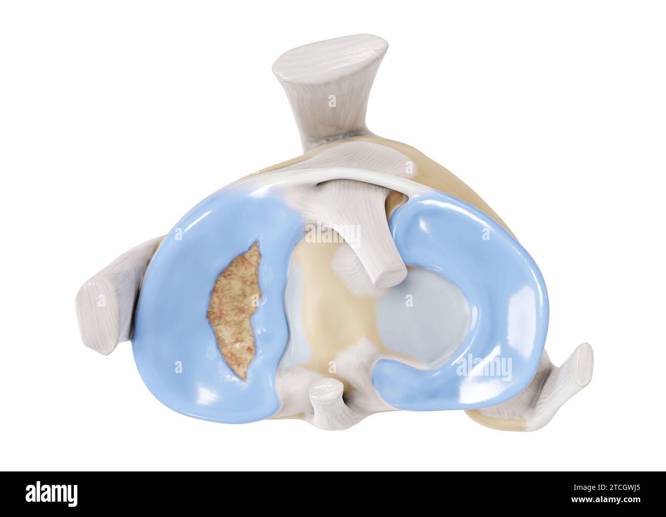 Illustration of a bucket handle tear in the medial meniscus on a right