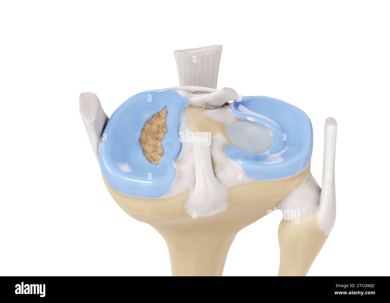 Illustration of a bucket handle tear in the medial meniscus on a right