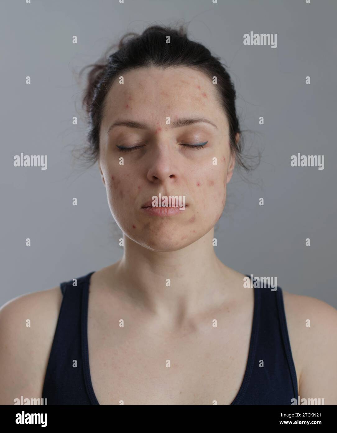 Unedited natural image of woman with dry damaged skin on her face and