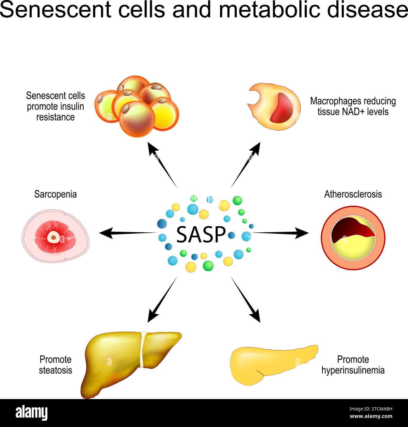 Senescent cells and metabolic disease. Senescence-associated secretory phenotype SASP. Senescent cells promote insulin resistance, liver steatosis, mu Stock Vector