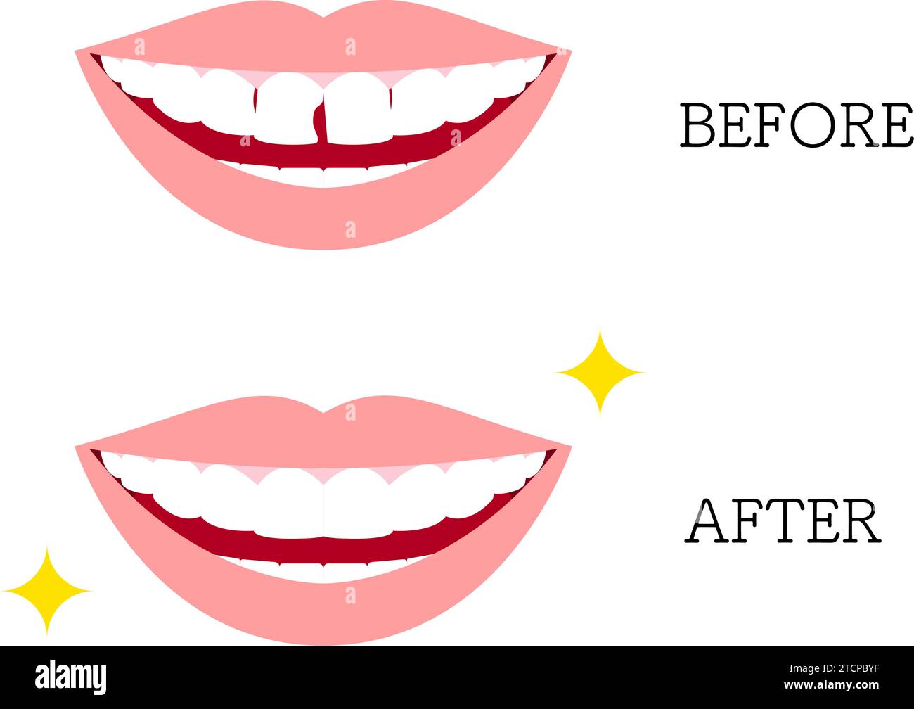Cosmetic Dentistry, Direct Bonding Before and After, Vector Illustration Stock Vector Image