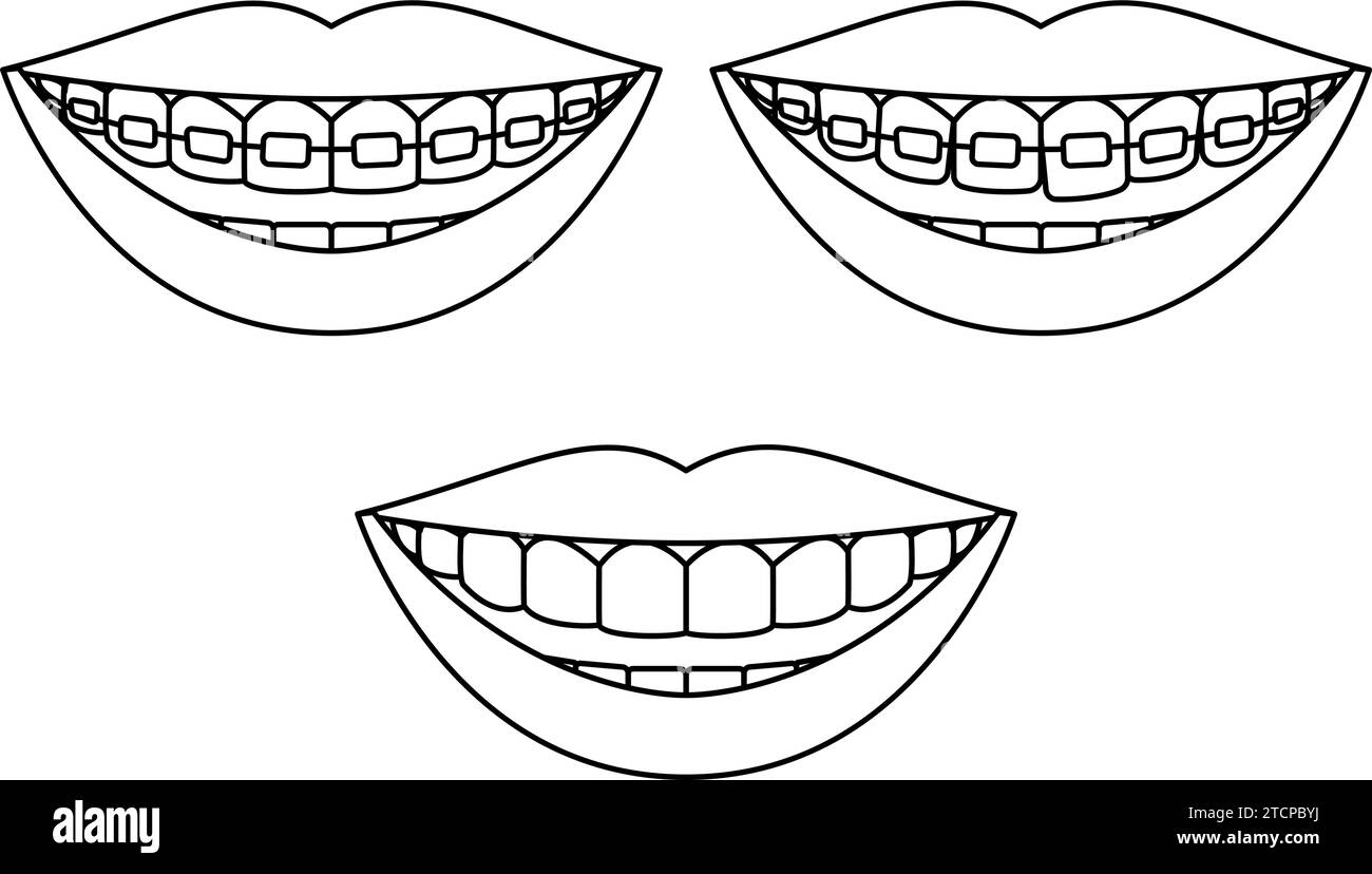 Teeth with metal brackets in cosmetic dentistry and orthodontics, simple line drawing, Vector Illustration Stock Vector
