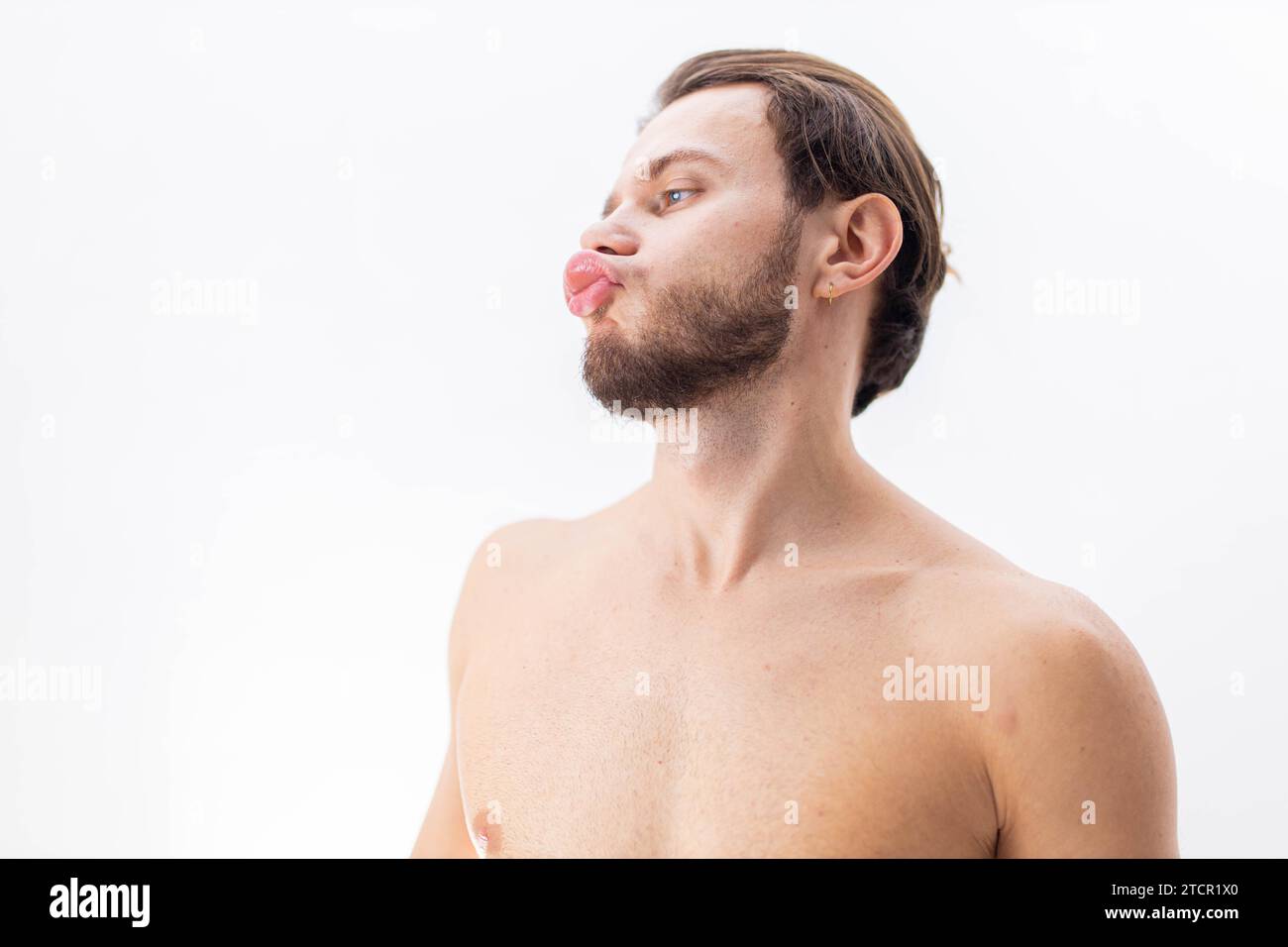 Migration of filler, hyaluronic acid, consequences of medical error, unsuccessful lip augmentation Stock Photo