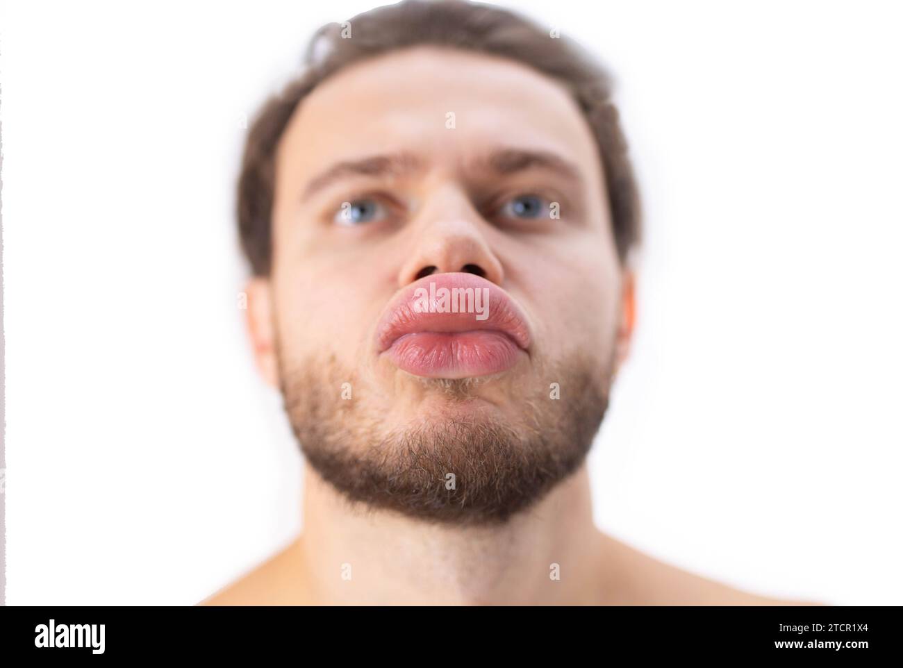 Allergic reaction on the lip angioedema in a man, consequences of