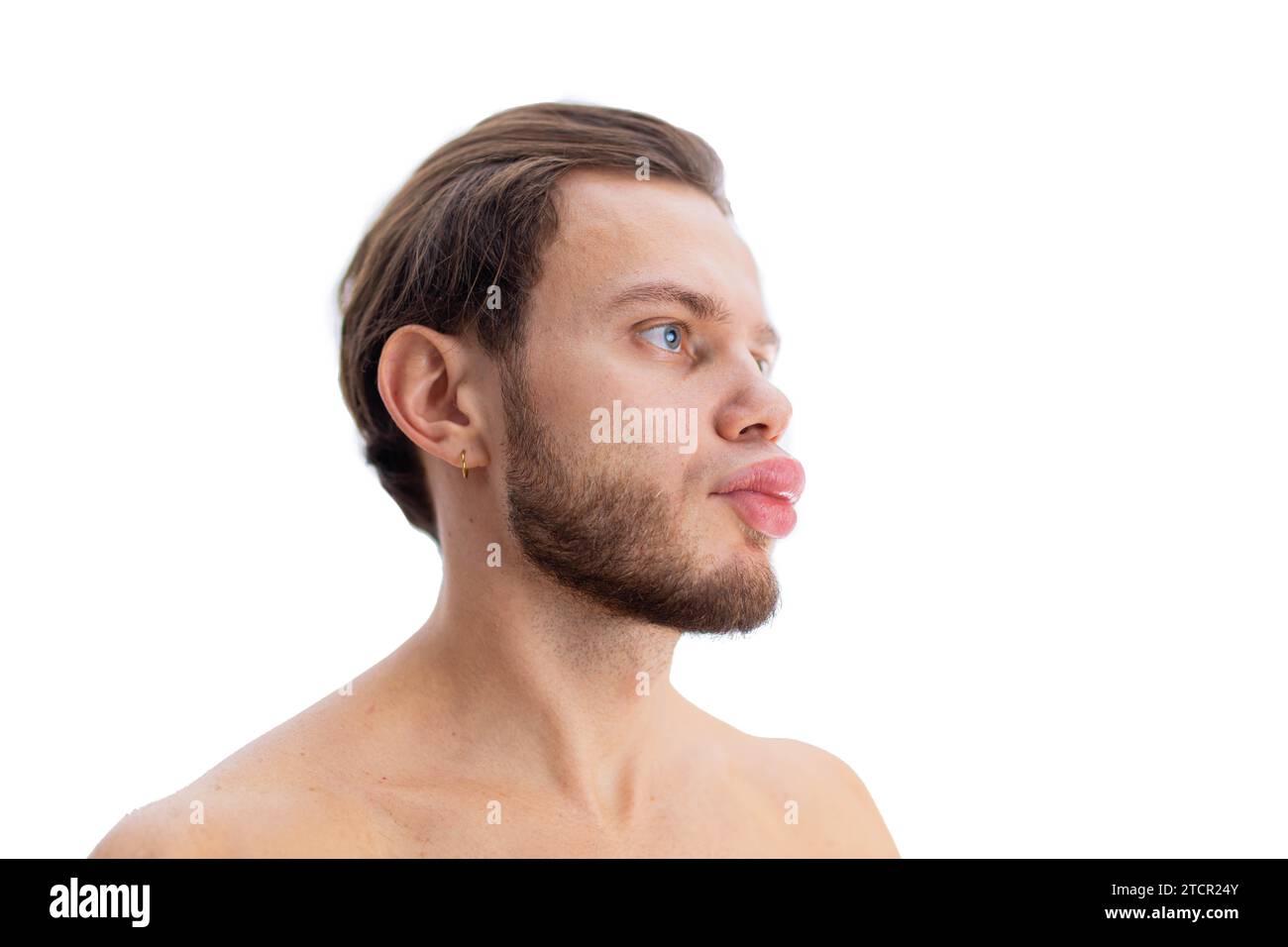 Allergic reaction on the lip angioedema in a man, consequences of hyaluronic acid injections