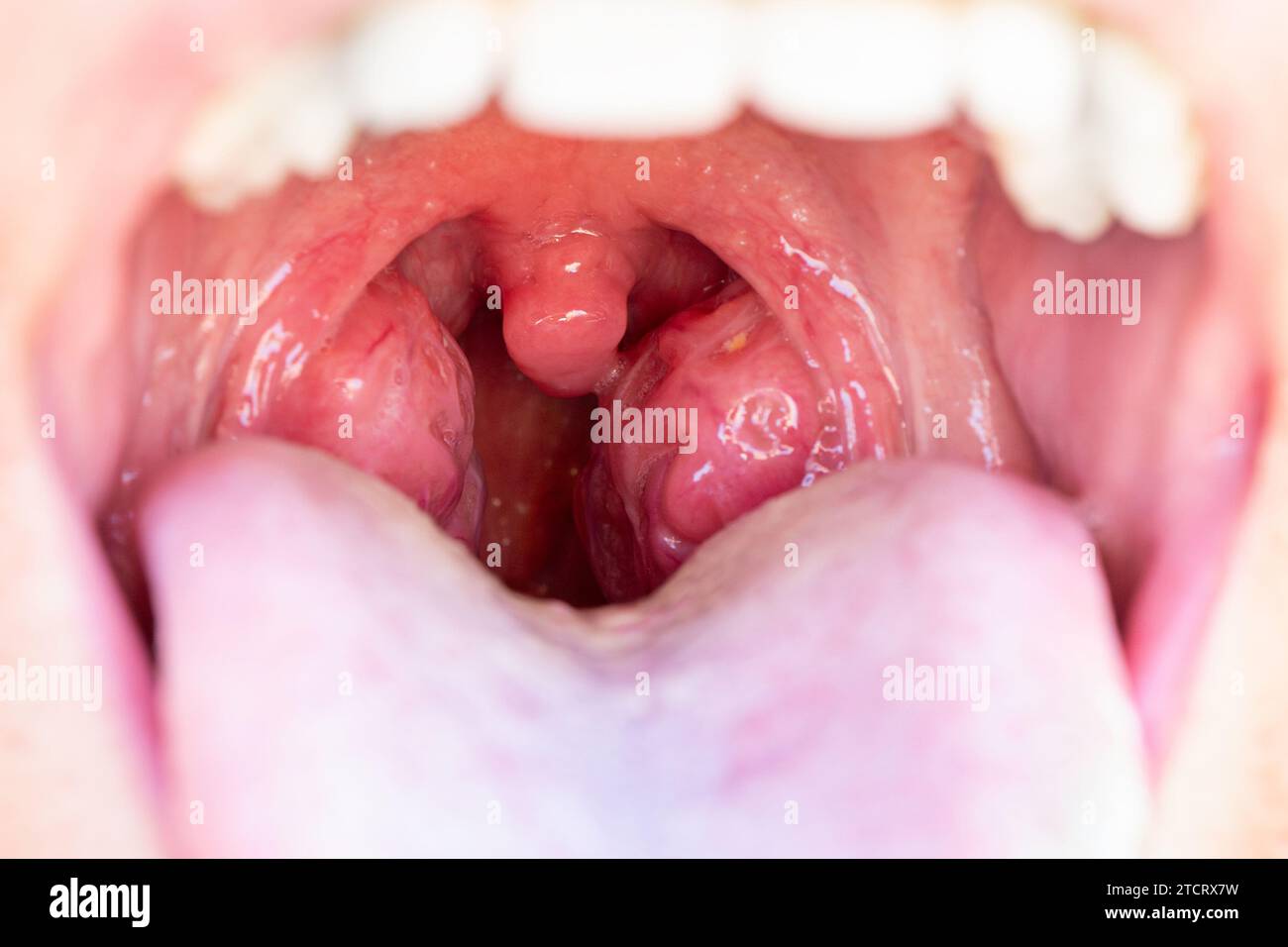 Closeup view of open mouth with tonsils. The child is a patient with large red glands. Tonsils in close-up in the mouth. Stock Photo