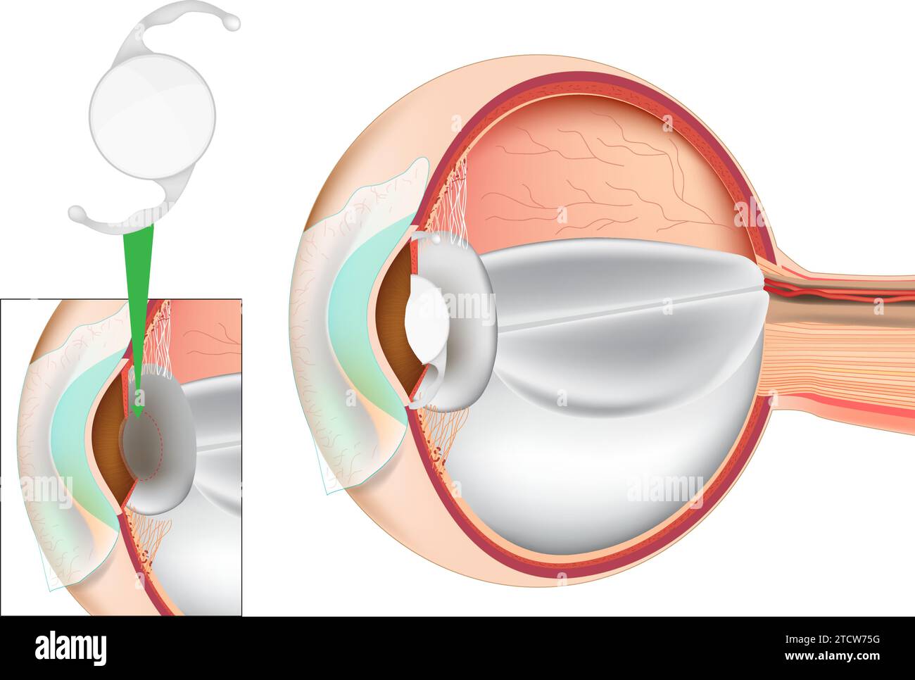 Eye Lens Replacement Surgery. Lens Implant. Cataract Surgery. Intraocular Lenses IOL. Stock Vector