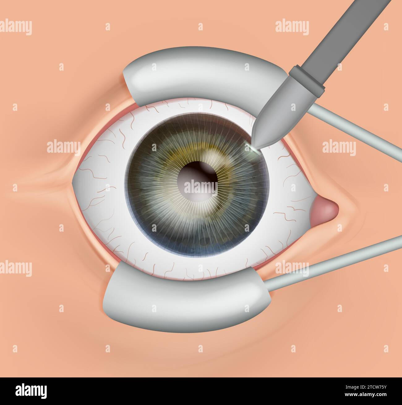 The procedure of eye surgery. Anatomy of the eye Stock Vector Image