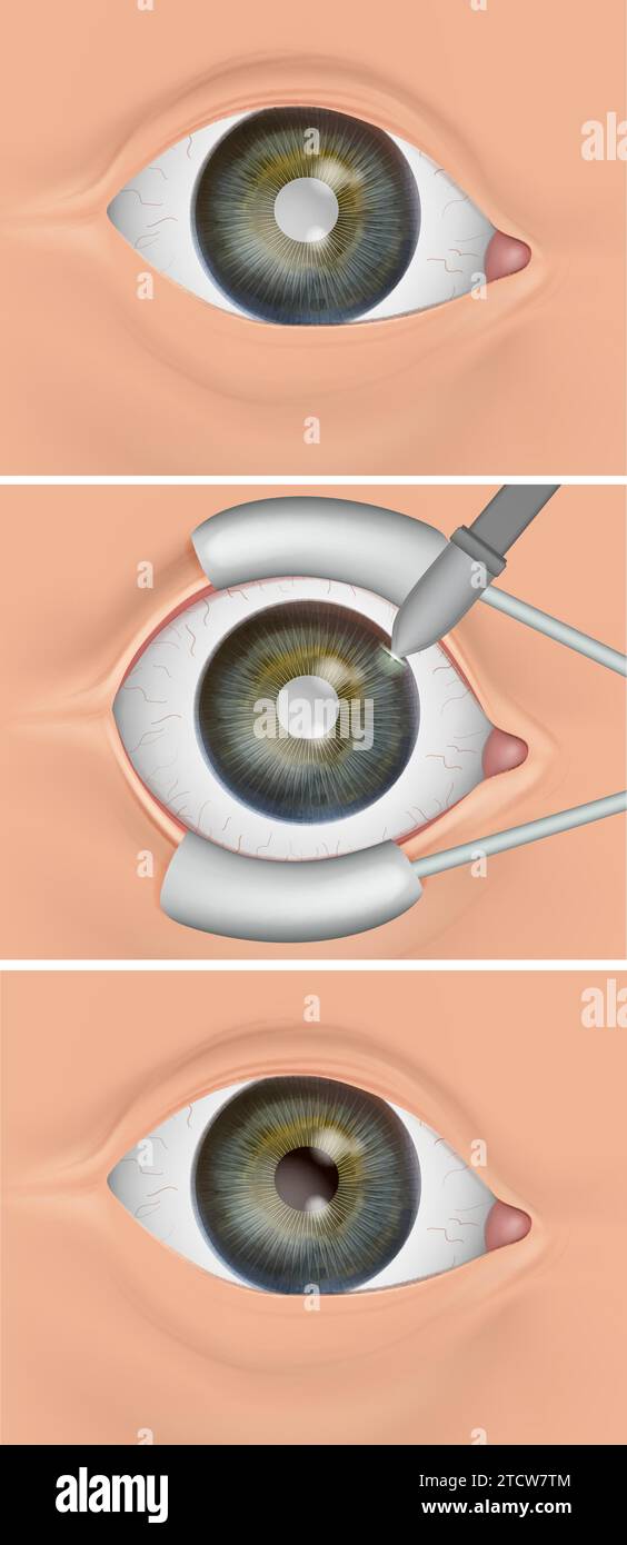 The Eyes Natural Lens Replaced With An Artificial Intraocular Lens IOL . Cataract Surgery, Also
