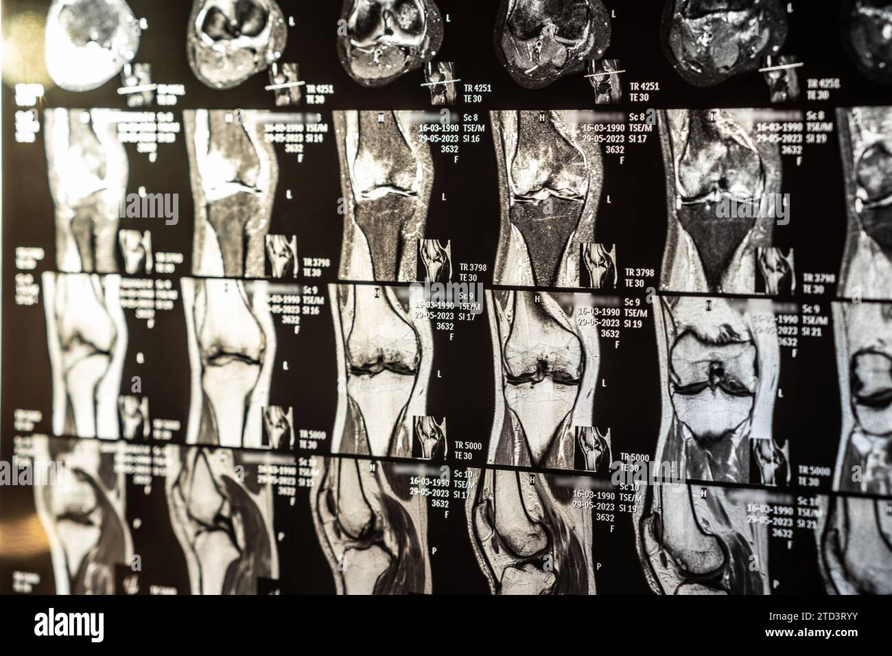 Magnetic resonance imaging of human knee joint for medical diagnosis ...