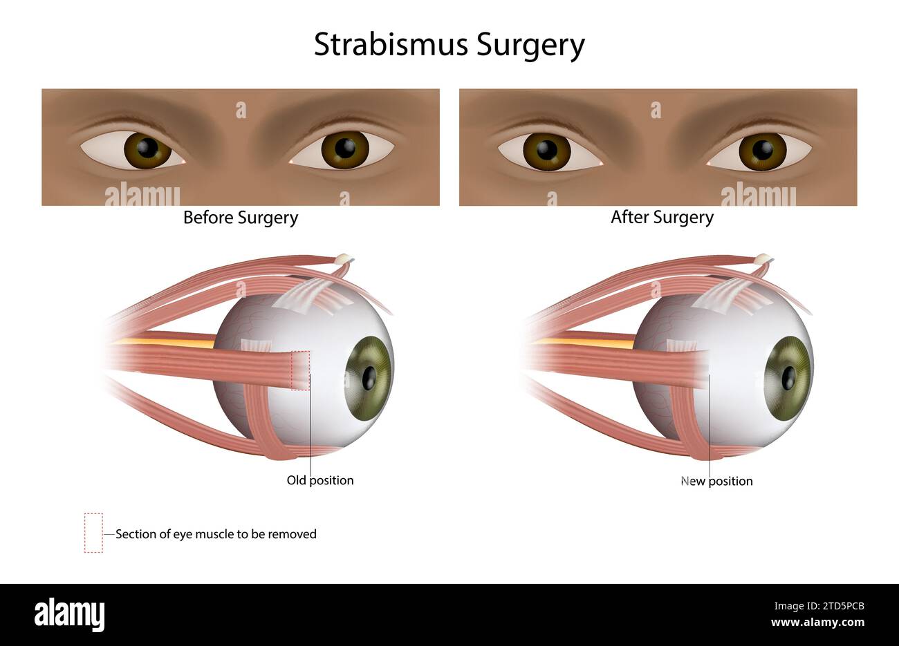 Strabismus or Squint surgery treats misaligned eyes. Eye Muscle Surgery. Stock Vector