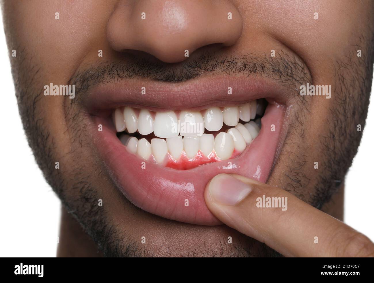 Man showing inflamed gum on white background, closeup Stock Photo