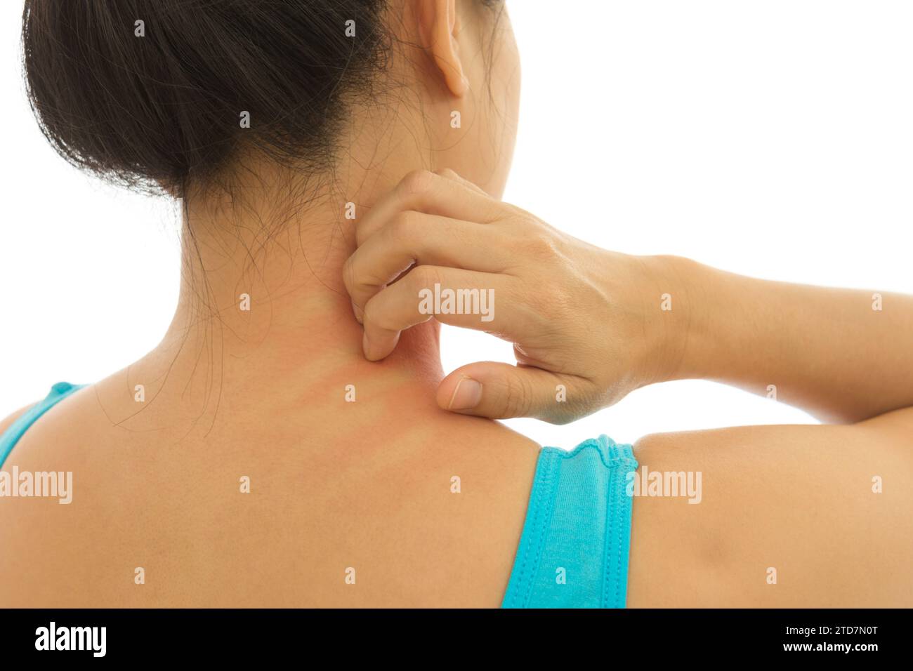 Roy rash red Itching of skin diseases in women using the hand